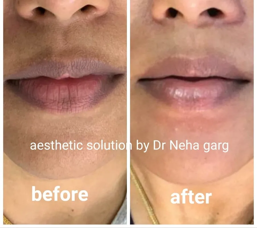 PRP Face TREATMENT2