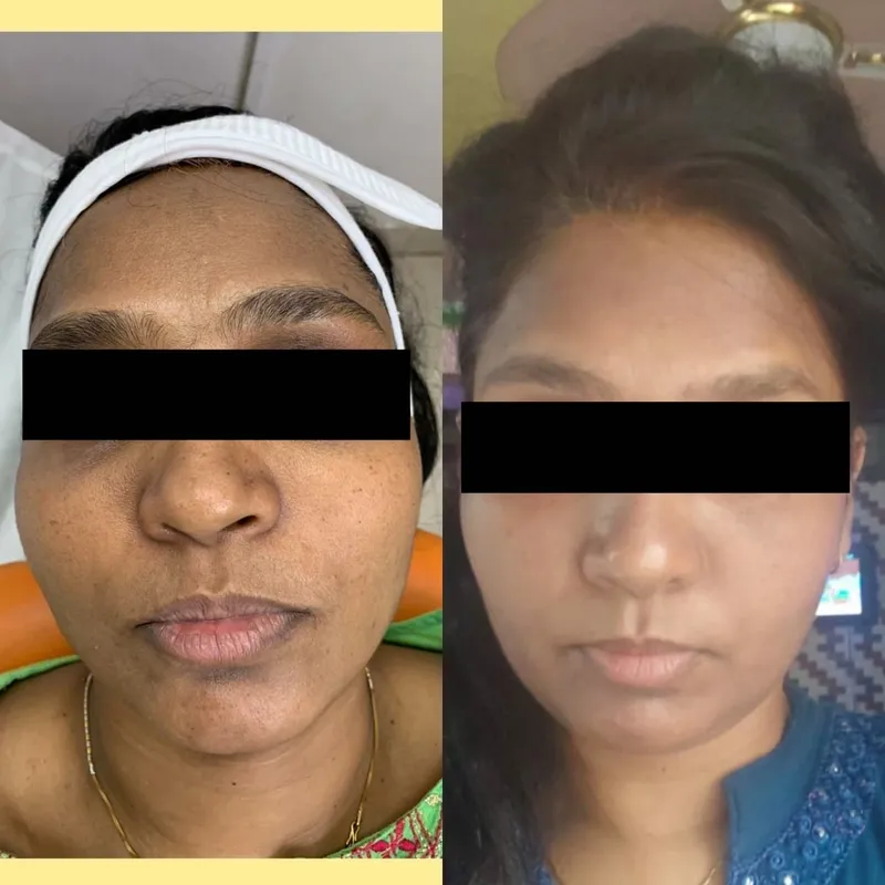 PRP Face TREATMENT4