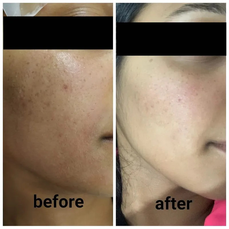PRP Face TREATMENT7